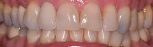 Before Veneers treatment at Kantor Dental Group in Marin County Smile 