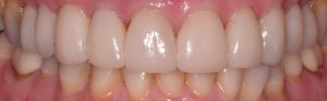 After Veneers treatment at Kantor Dental Group in Marin County Smile 