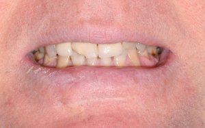 before veneers