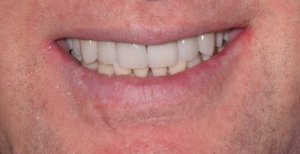 after veneers