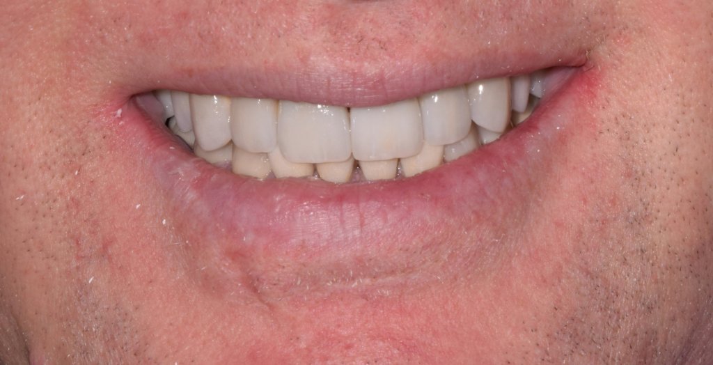 after veneers
