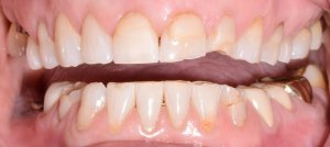Upper anterior crowding, rotated centrals, diastema, uneven incisal edges, mild gingival inflammation