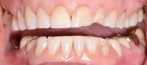 Before & After Photos of Full Mouth Treatment