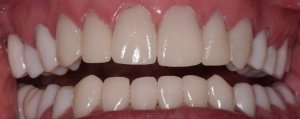 Aligned upper teeth, closed diastema, symmetrical gingiva, natural shade, improved smile line