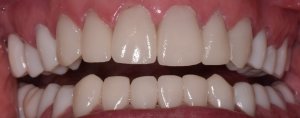 Before & After Photos of Full Mouth Treatment