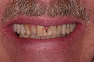 Before Veneers treatment for men at Kantor Dental Group in Marin County