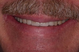 After Veneers treatment for men at Kantor Dental Group in Marin County