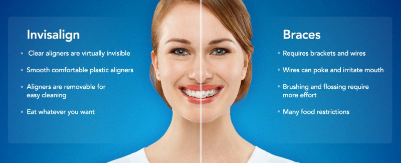 Split-image comparison: left—“Invisalign” with bullet points (virtually invisible, removable, easy cleaning); right—“Braces” with bullets (requires brackets/wires, poking risk, food restrictions); smiling woman centered