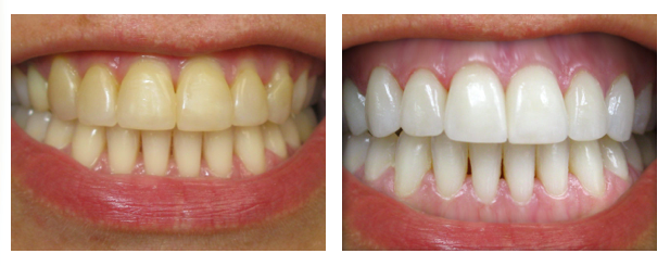 before and after teeth whitening