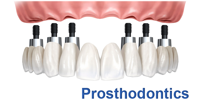 Dental prosthodontics illustration: 6 dental implants with abutments supporting a fixed porcelain bridge; pink gingiva mimic above. Below, blue text reads “Prosthodontics”