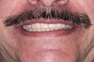After Veneers treatment for men at Kantor Dental Group in Marin County