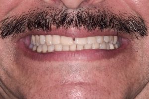 Before Veneers treatment for men at Kantor Dental Group in Marin County