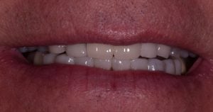 Before & After Photos of Full Mouth Treatment