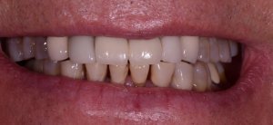 Before & After Photos of Full Mouth Treatment