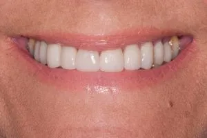 After photo of dental implant treatment at Kantor Dental Group in Marin County
