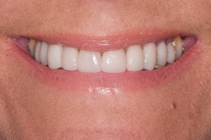 After photo of dental implant treatment at Kantor Dental Group in Marin County
