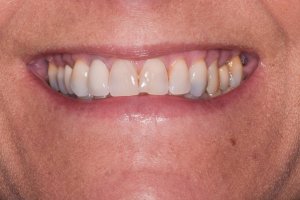 After photo of dental implant treatment at Kantor Dental Group in Marin County