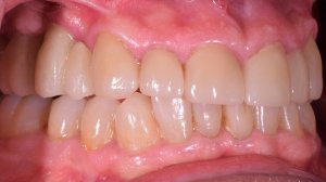 Before & After Photos of Full Mouth Treatment
