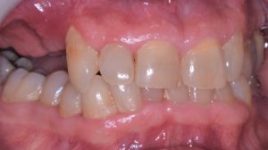 Before & After Photos of Full Mouth Treatment