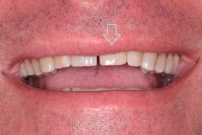 Dental implant case 1 with arrow