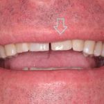 Dental implant case 1 with arrow