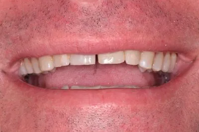 Dental implant case 1