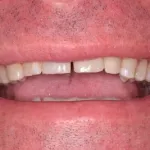 Dental implant case 1