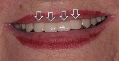 Dental implant case 2 with arrow