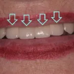 Dental implant case 2 with arrow