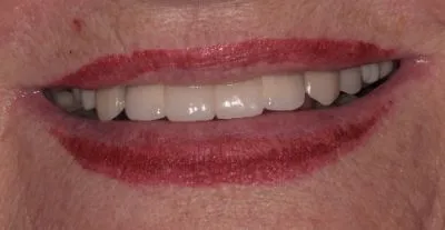 Dental implant case 2