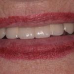 Dental implant case 2