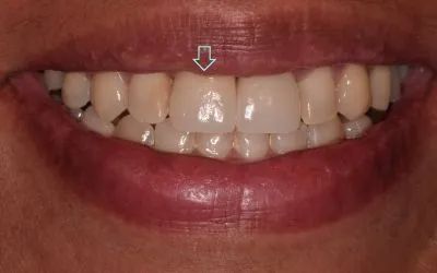 Dental implant case 3 with arrow