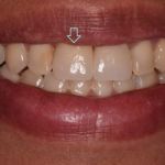 Dental implant case 3 with arrow