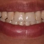 Dental implant case 3