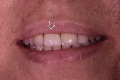 Dental implant case 5 with arrow