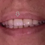 Dental implant case 5 with arrow