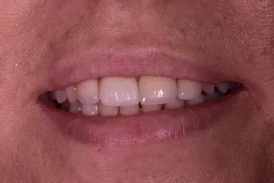 Dental implant case 5