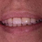Dental implant case 5