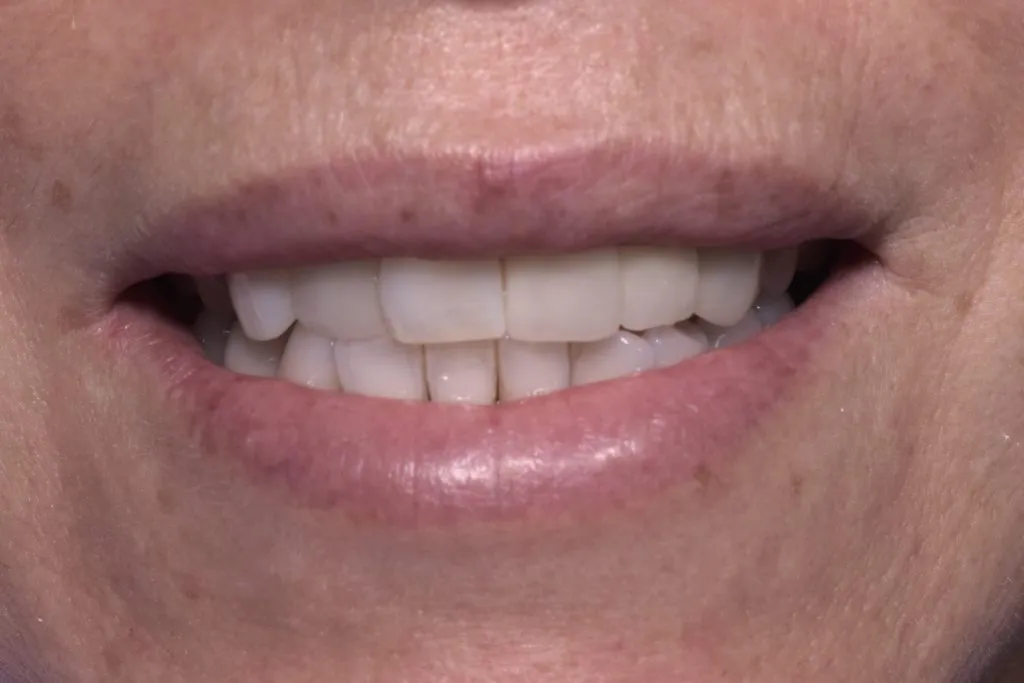 Before and after cosmetic dental implants | Kantor Dental Group
