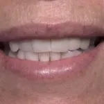 Before and after cosmetic dental implants | Kantor Dental Group