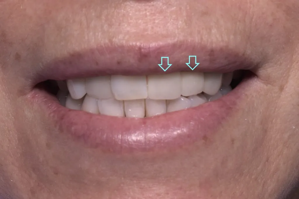 Before and after cosmetic dental implants | Kantor Dental Group