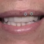 Before and after cosmetic dental implants | Kantor Dental Group