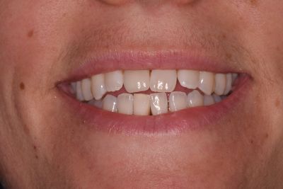 Dental implant case 6