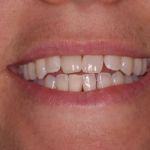 Dental implant case 6