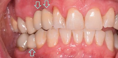 Dental implant case 7 with arrow