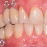 Dental implant case 7 with arrow