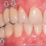 Dental implant case 7 with arrow
