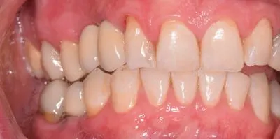 Dental implant case 7