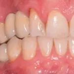 Dental implant case 7