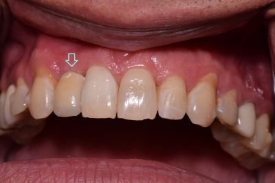 Dental implant case 10 with arrow